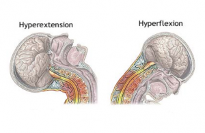 Hyperflexion Hyperextension Cervicale Cycl Osteo